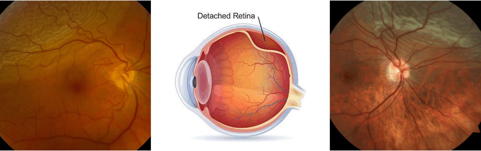 photo - retinal detachment